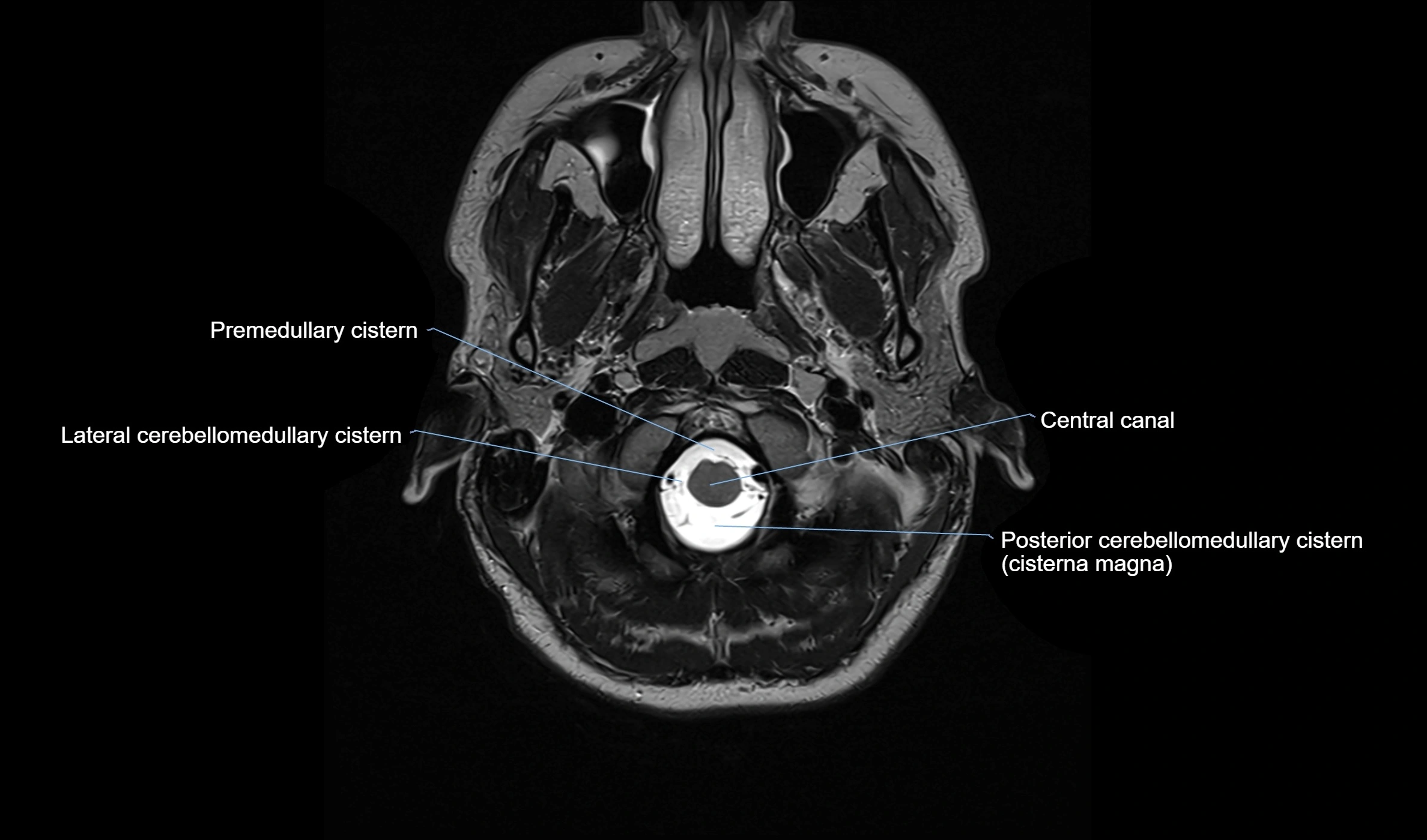 Brain cisterns  and ventricles  axial anatomy 3T MRI image-img-00001-00001.webp